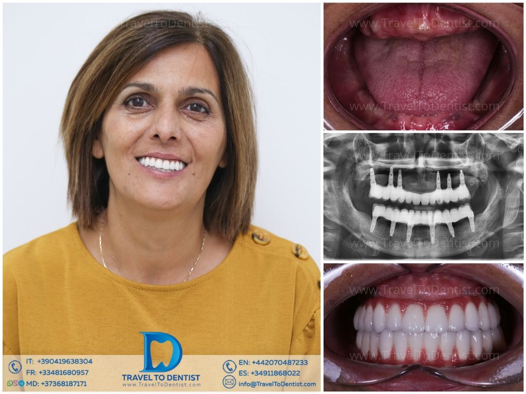 Caso clínico 5 - transformación dental