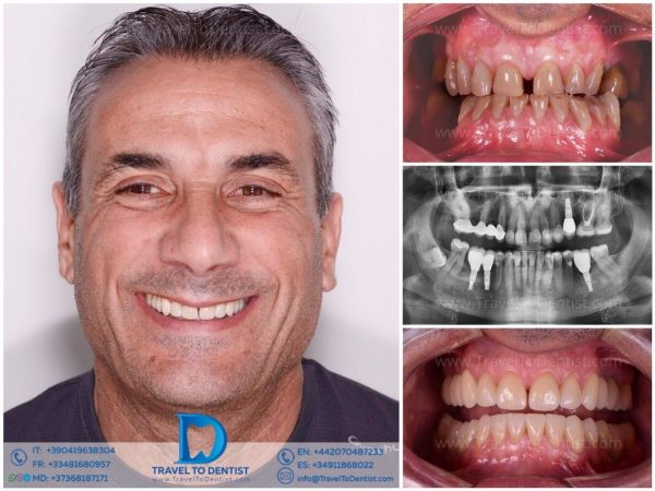 Caso clínico 2 - transformación dental