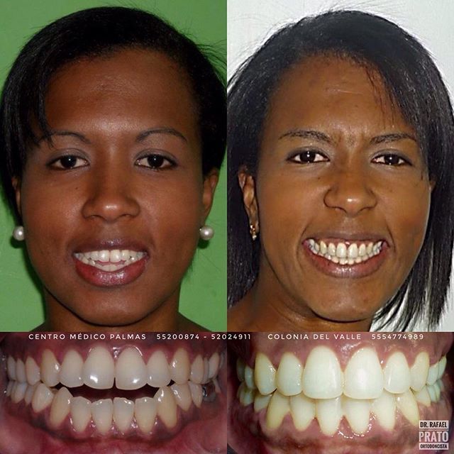 Caso clínico 4 - transformación dental